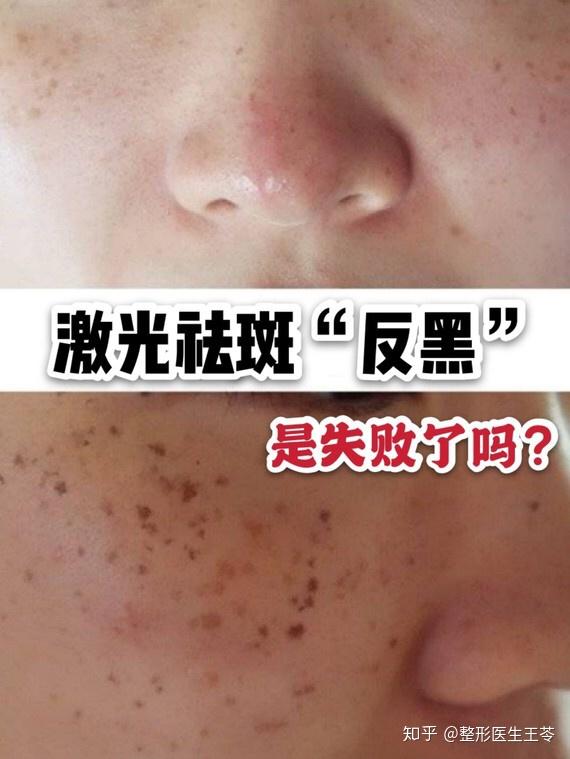 激光祛斑反黑07是失败了吗0571