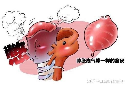 急性会厌炎起病突然,发病迅速,以会厌高度水肿引起的剧烈咽喉痛,吞咽