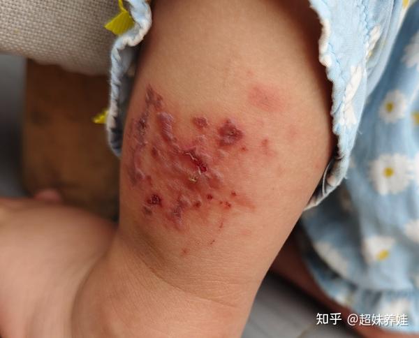 回山上避疫情,但宝宝不仅被蚊子咬,还被牛虻叮出一片大水泡!