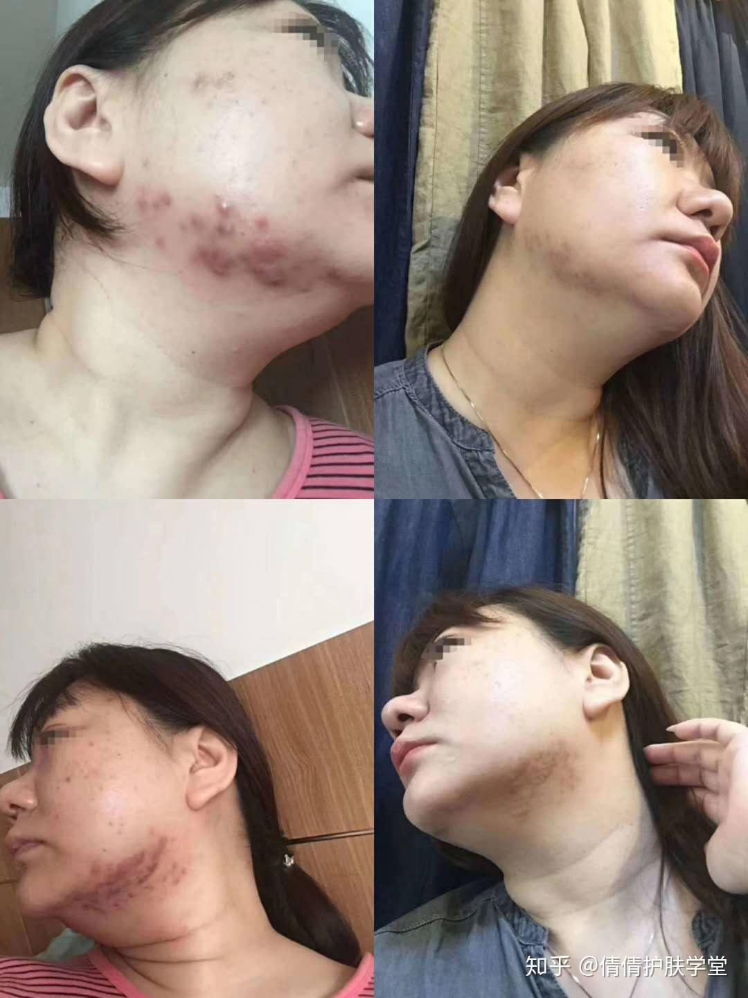 脸上起痘和鸡皮疙瘩(脸上有像鸡皮疙瘩一样的痘痘是怎么回事) 脸上起痘和鸡皮疙瘩(脸上有像鸡皮疙瘩一样的痘痘是怎么回事)