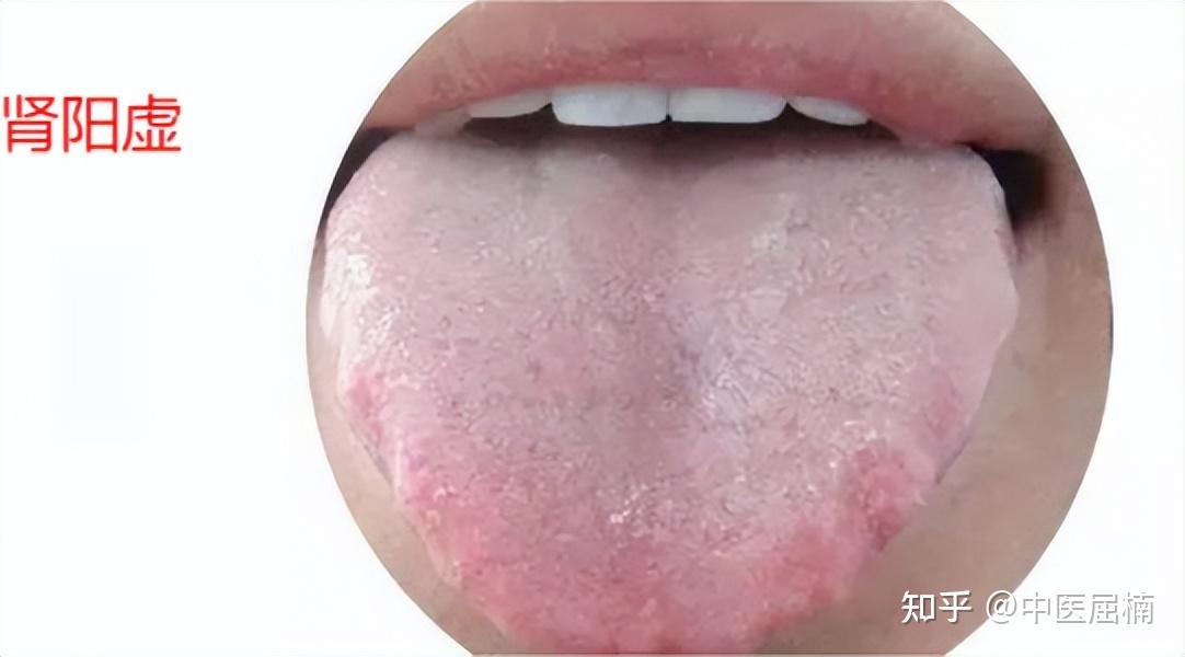 同样是肾虚,为什么舌苔不一样?屈医生分析下常见的4种肾虚舌象 - 知乎