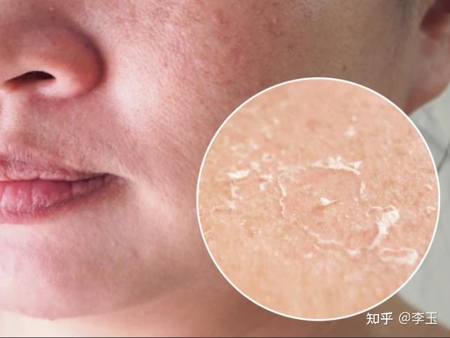 秋季脸部干燥缺水怎么办美容院diy自制天然补水面膜配方