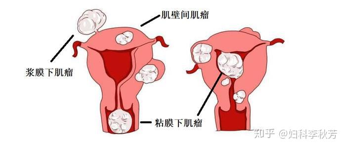 子宫肌瘤超过了5公分就必须要做手术也许你并不需要治疗