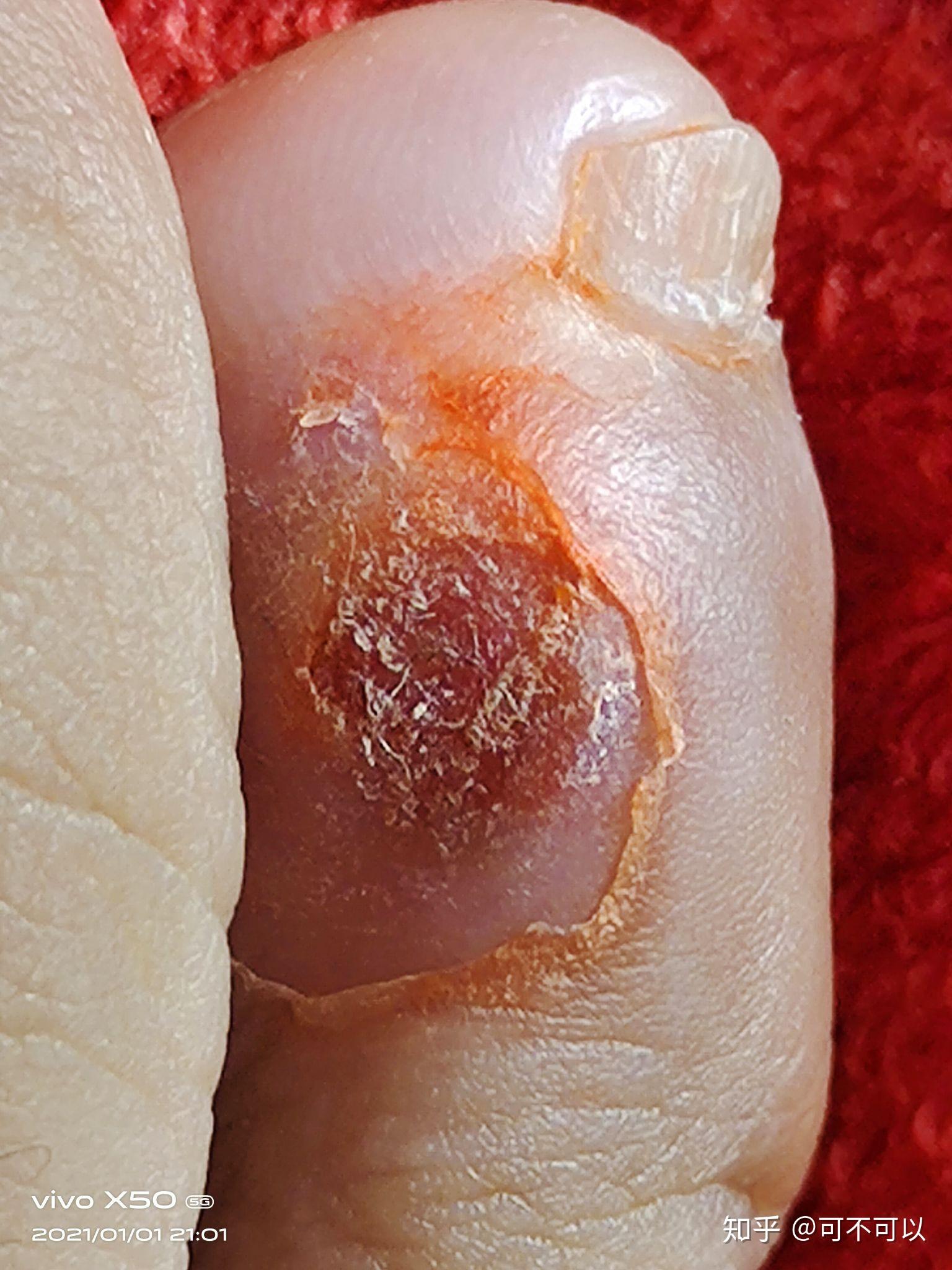 第一次长鸡眼 - 知乎