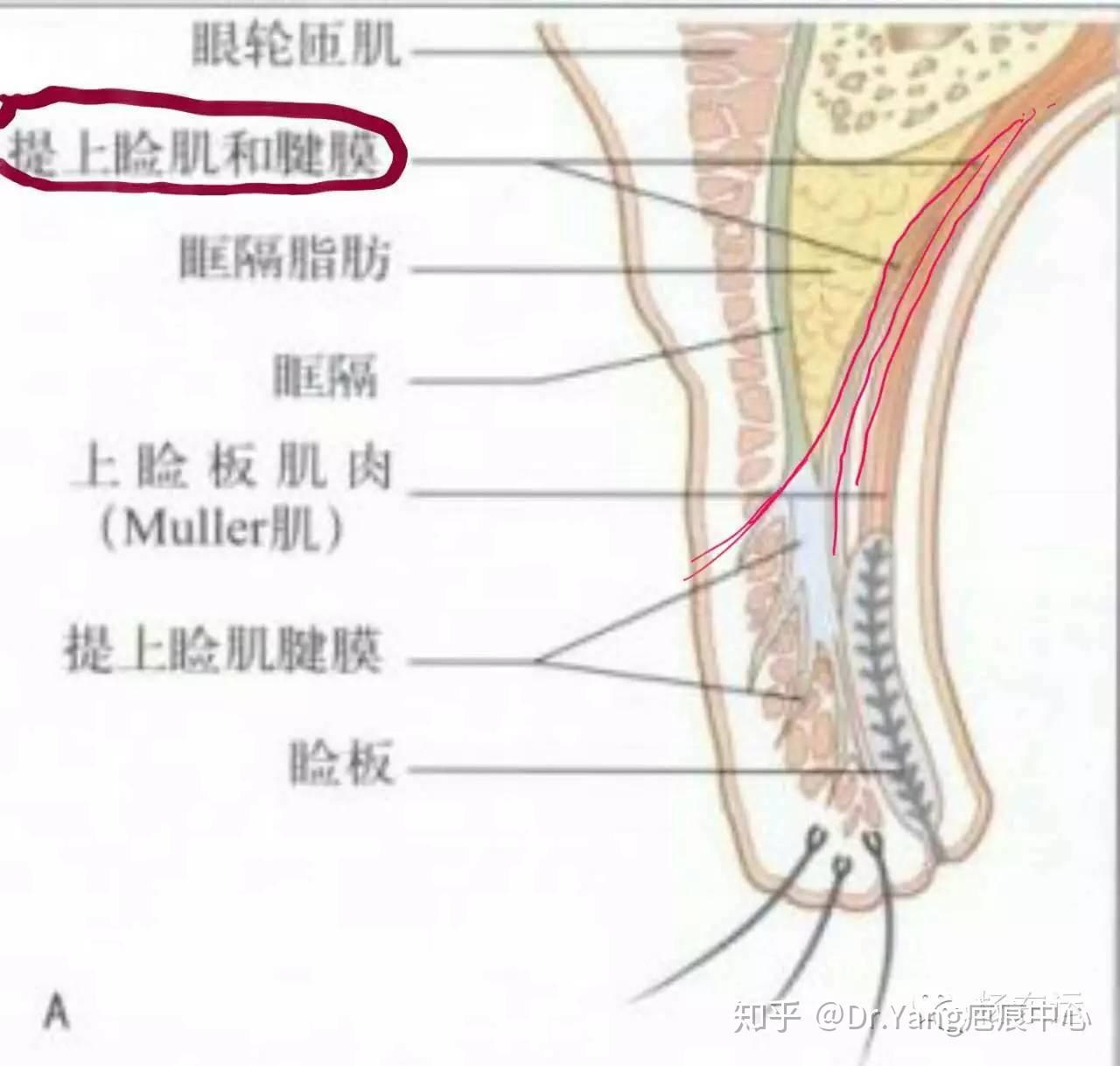 有的人天生就是双眼皮,那是因为他(她)的提上睑肌腱膜有止点止于上