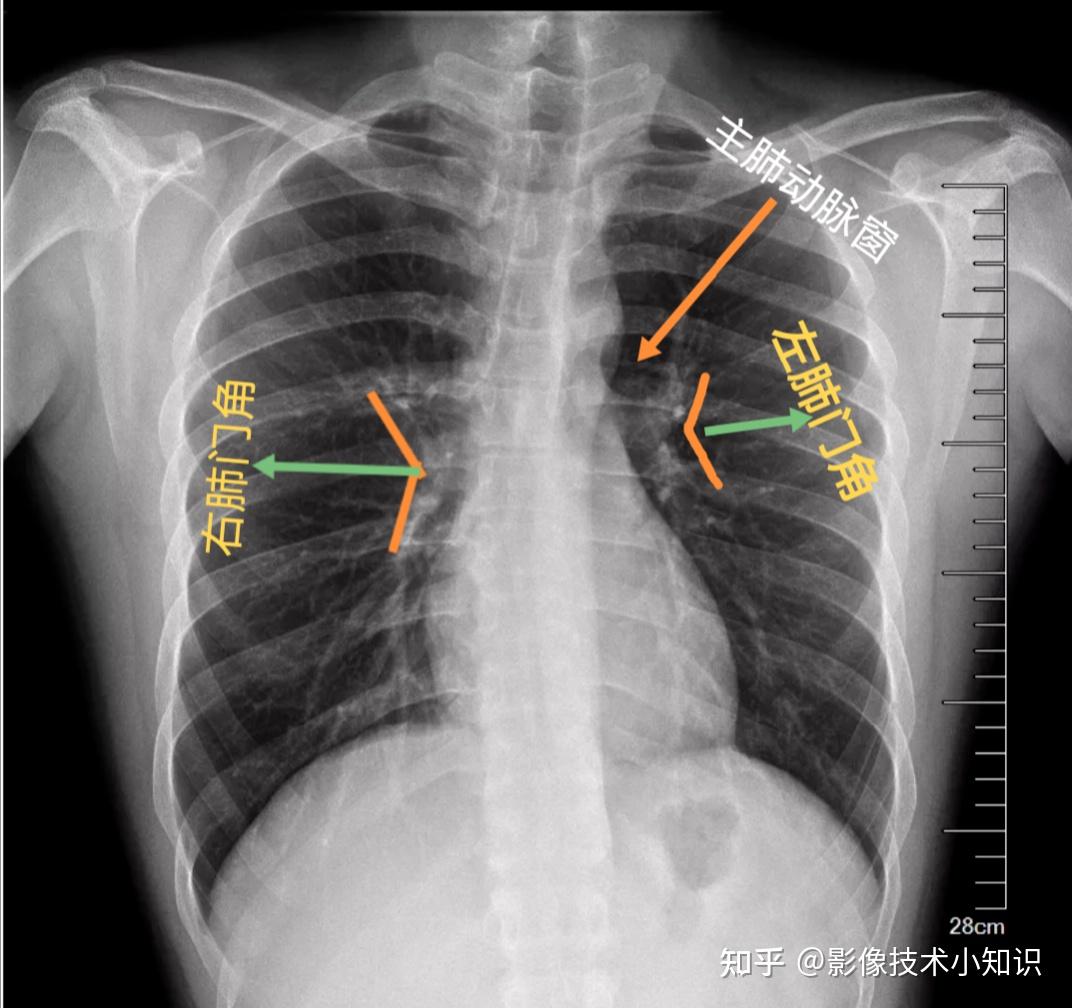 肺门不张图片