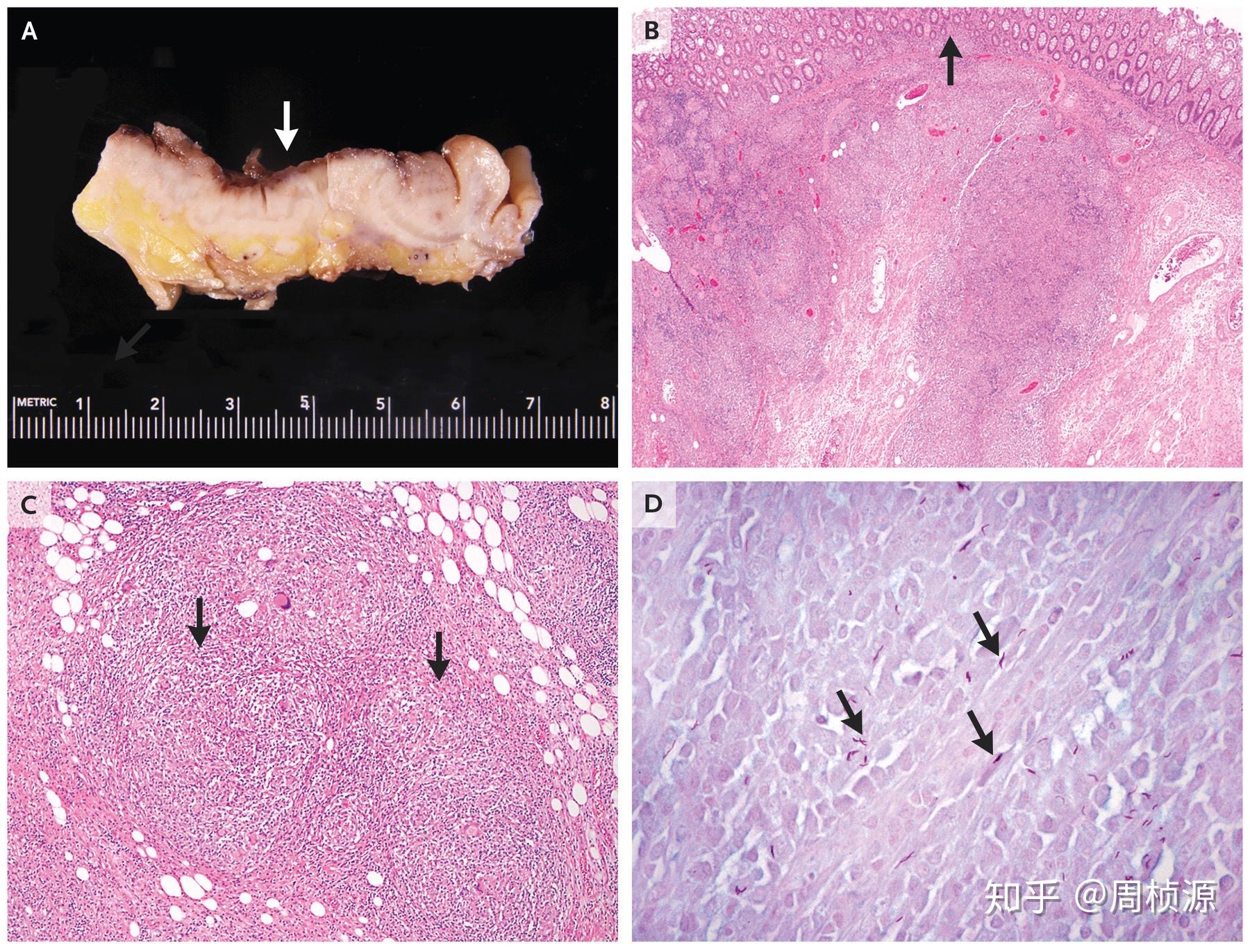 肺ct提示右肺尖纤维条索,肺小结节及纵膈淋巴结肿大支气管镜淋巴结