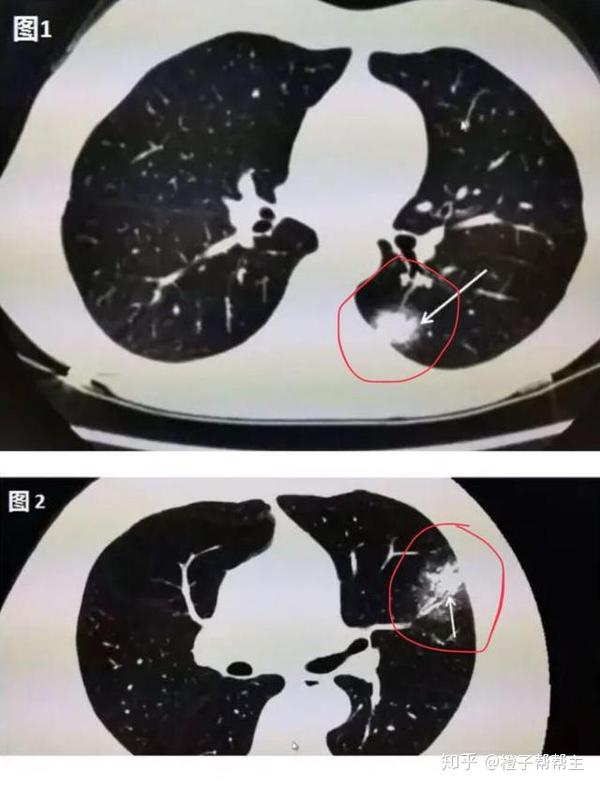 新冠肺炎的ct图片肺部图片