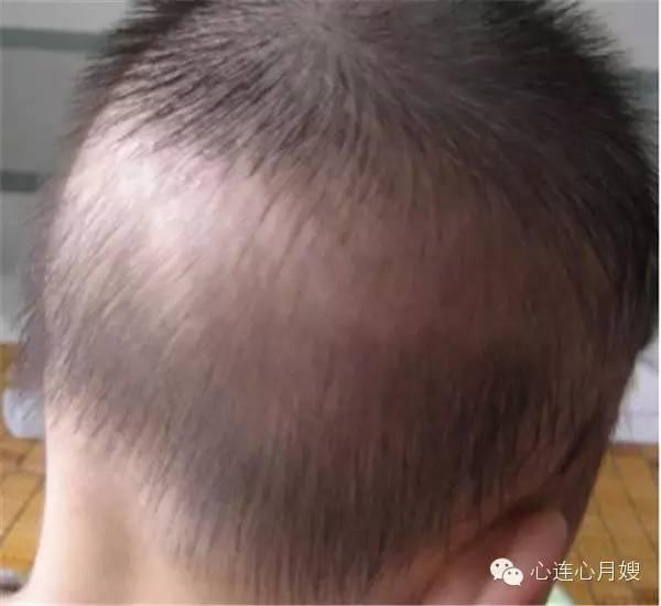 婴儿一般几个月出现枕秃 v2-1a99ff6987c0d72922c70220d70a48e7_r.jpg