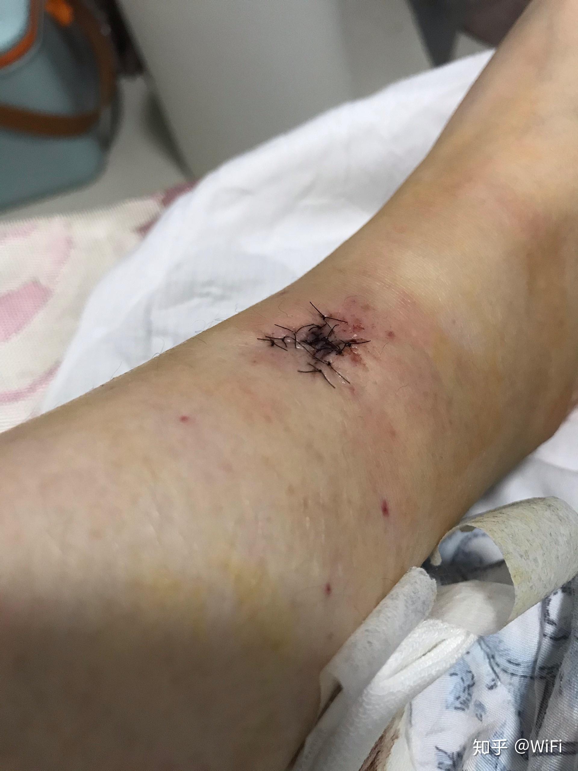 脚踝切痣手术皮瓣手术记录