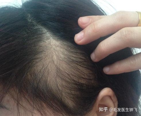 头发变细软稀疏如何增粗增密