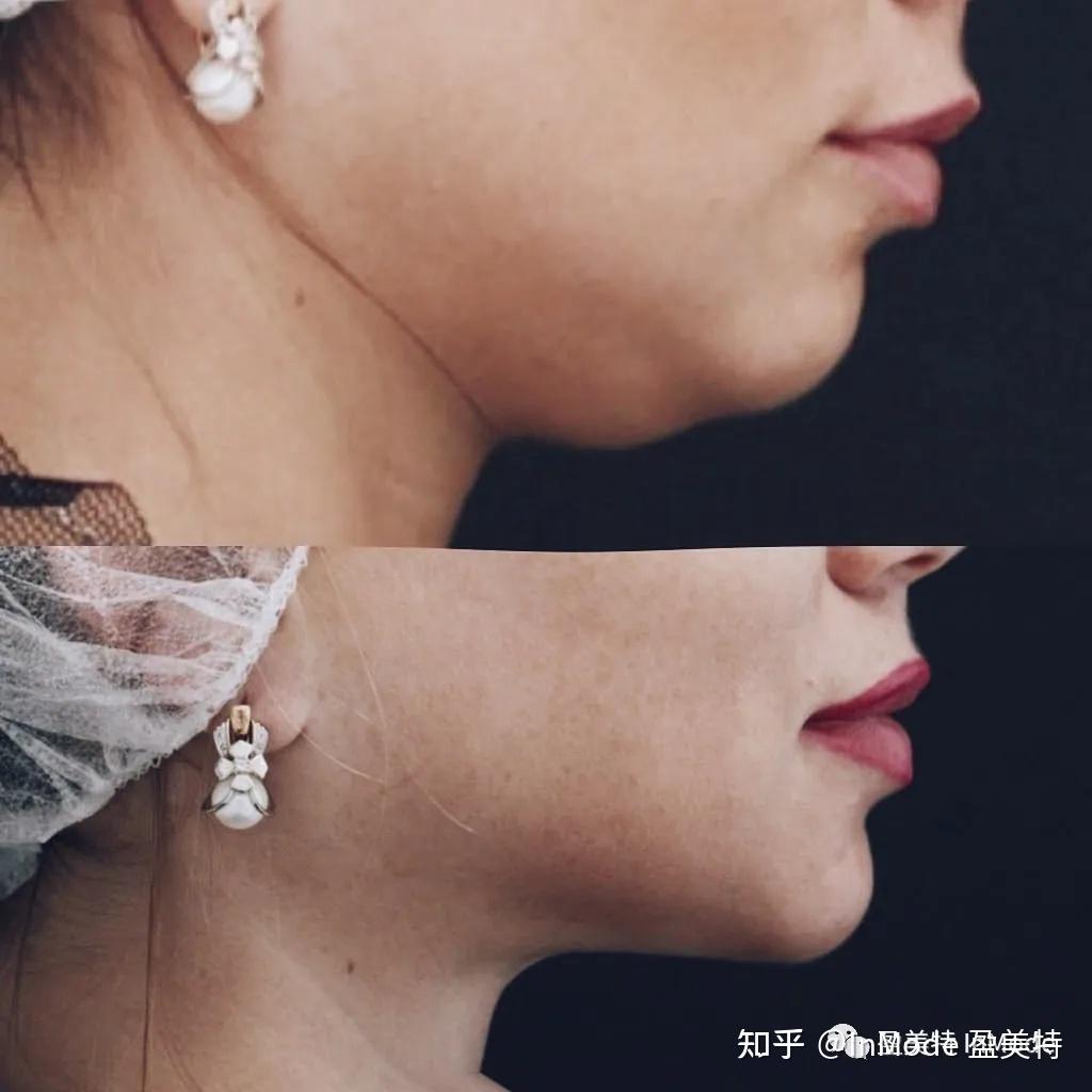 embracerf钻石精雕facetite面部脂肪抗衰