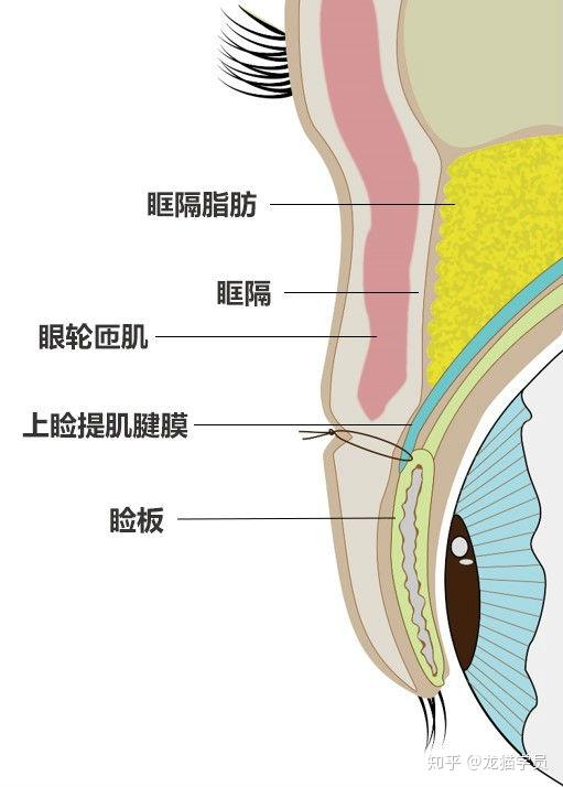 双眼皮成型的原理是将皮肤与睑板固定粘连,形成褶皱.