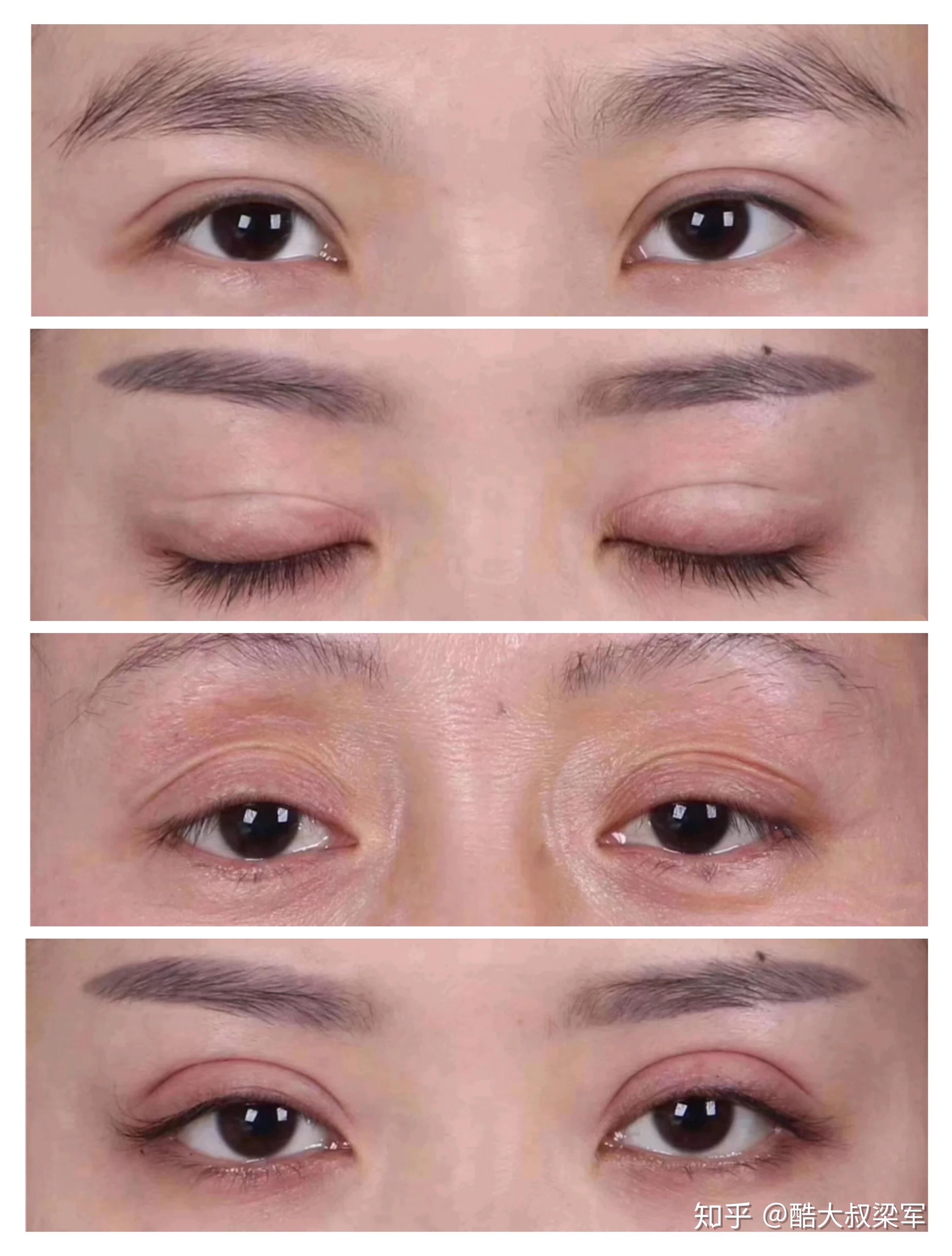 1, 重睑线消失:由于埋线不牢靠或切除不当造成双眼皮消失.