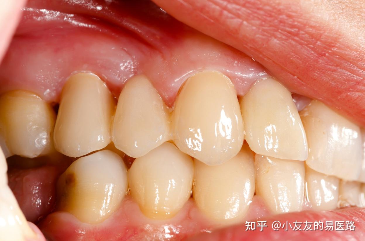 牙周袋深出血——中度牙周炎龈下刮治一例 - 知乎