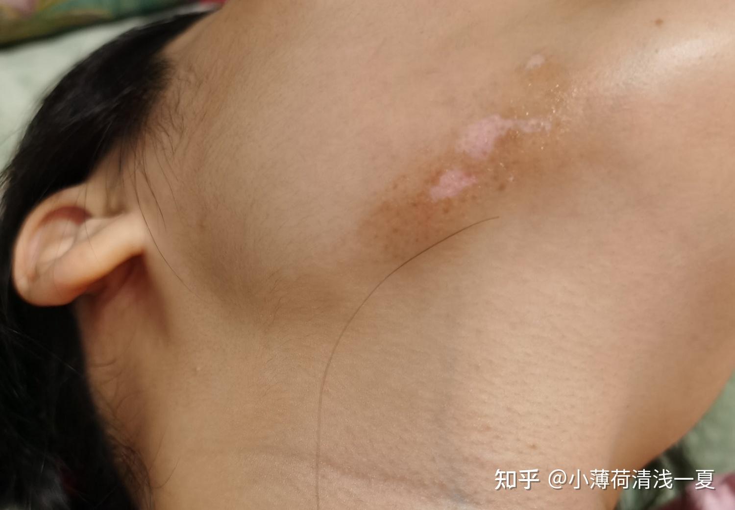 白癜风三个月成功复色 - 知乎