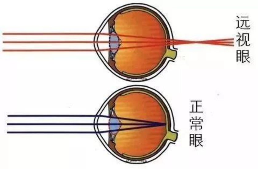 远视:就是看近模糊,看远清晰? - 知乎