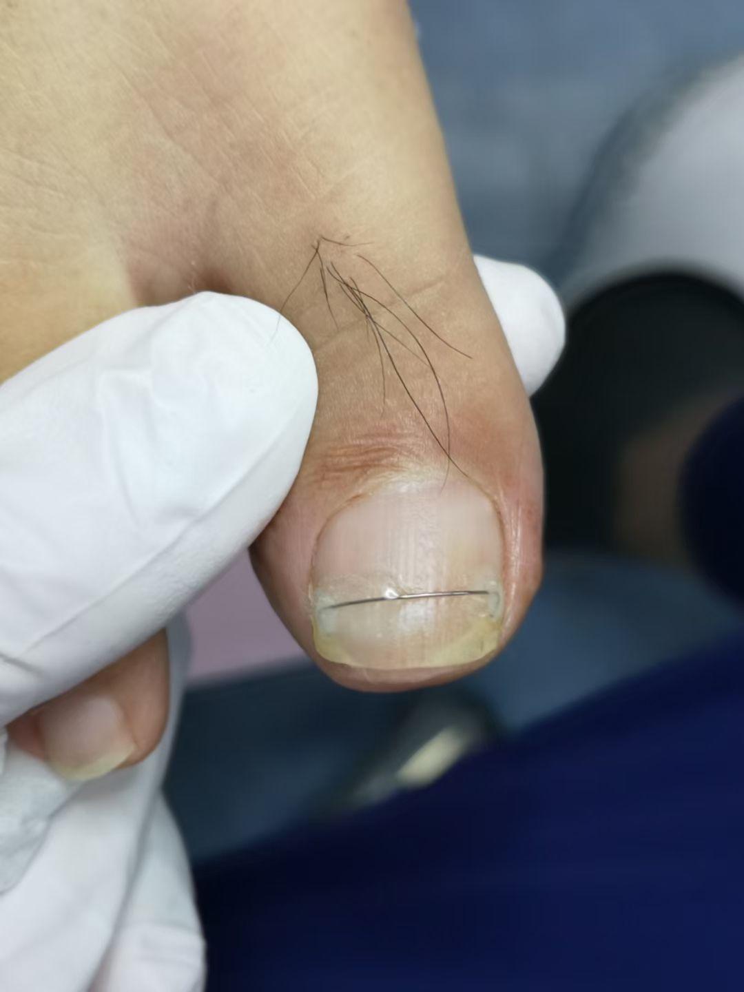 关于嵌甲甲沟炎矫正治疗