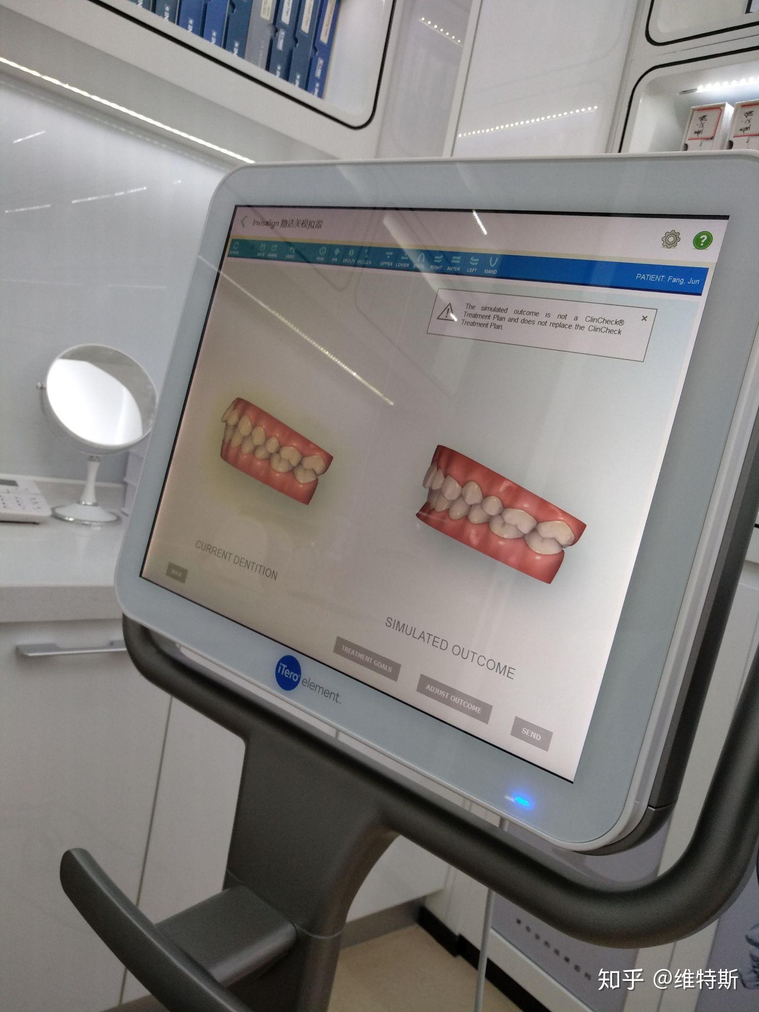 美国damon3mx金属自锁托槽牙套