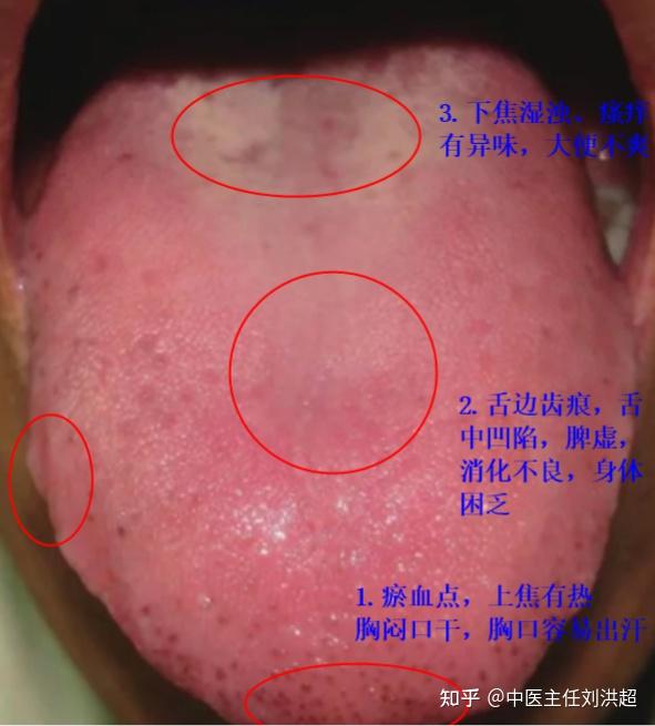 舌诊分享:舌尖红点和黑点都代表了什么?中医两个案例告诉你! - 知乎