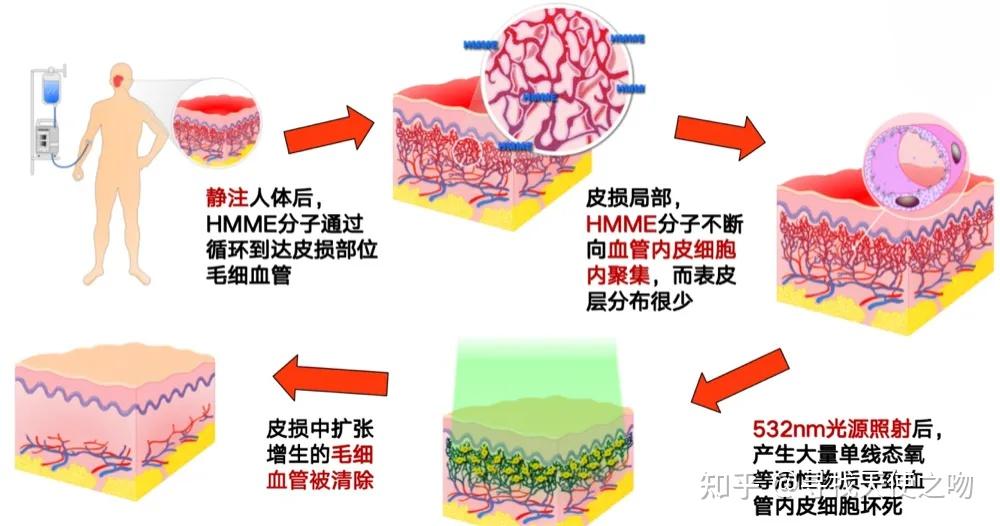 抗红辞典第三期:做光动力治疗前,我们需要了解这6个名词—— - 知乎