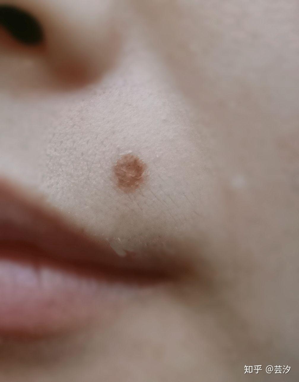 一个关于冷冻祛痣液氮的记录贴