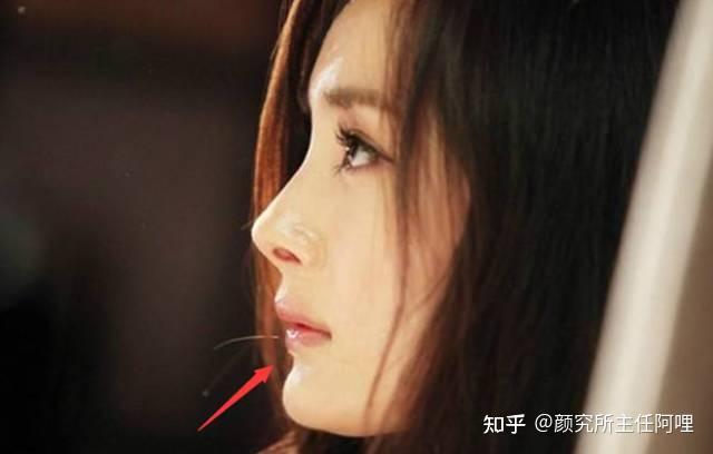 嘴突与面下三分之一美学 | "美人三分龅",是骗你的