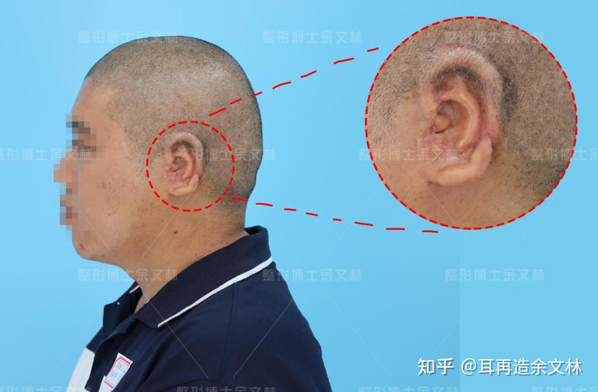 耳朵畸形可以申请什么补助_耳朵畸形需要多少钱_医院耳朵畸形