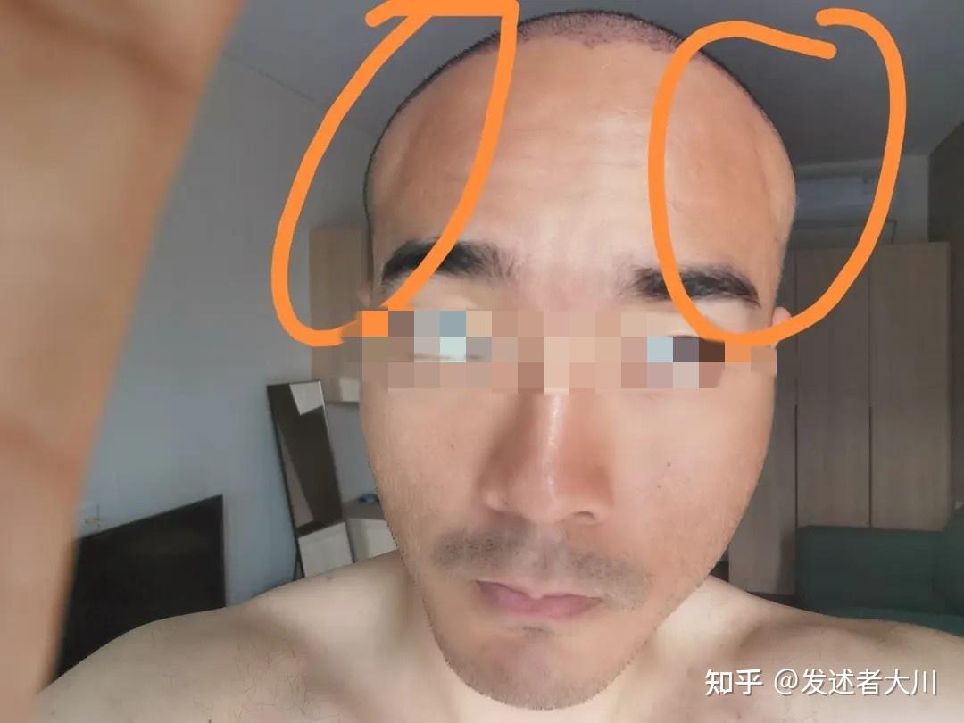 关于雍禾植发正规吗植发的信息