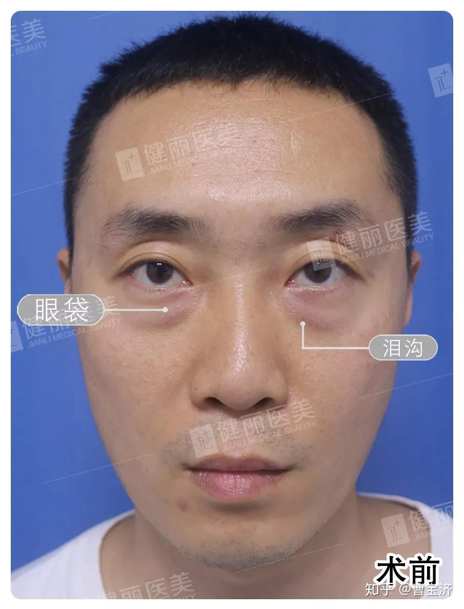 35岁的他去掉多年的眼袋泪沟瞬间年轻了好几岁