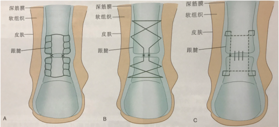 跟腱断裂的治疗方式开放修复篇