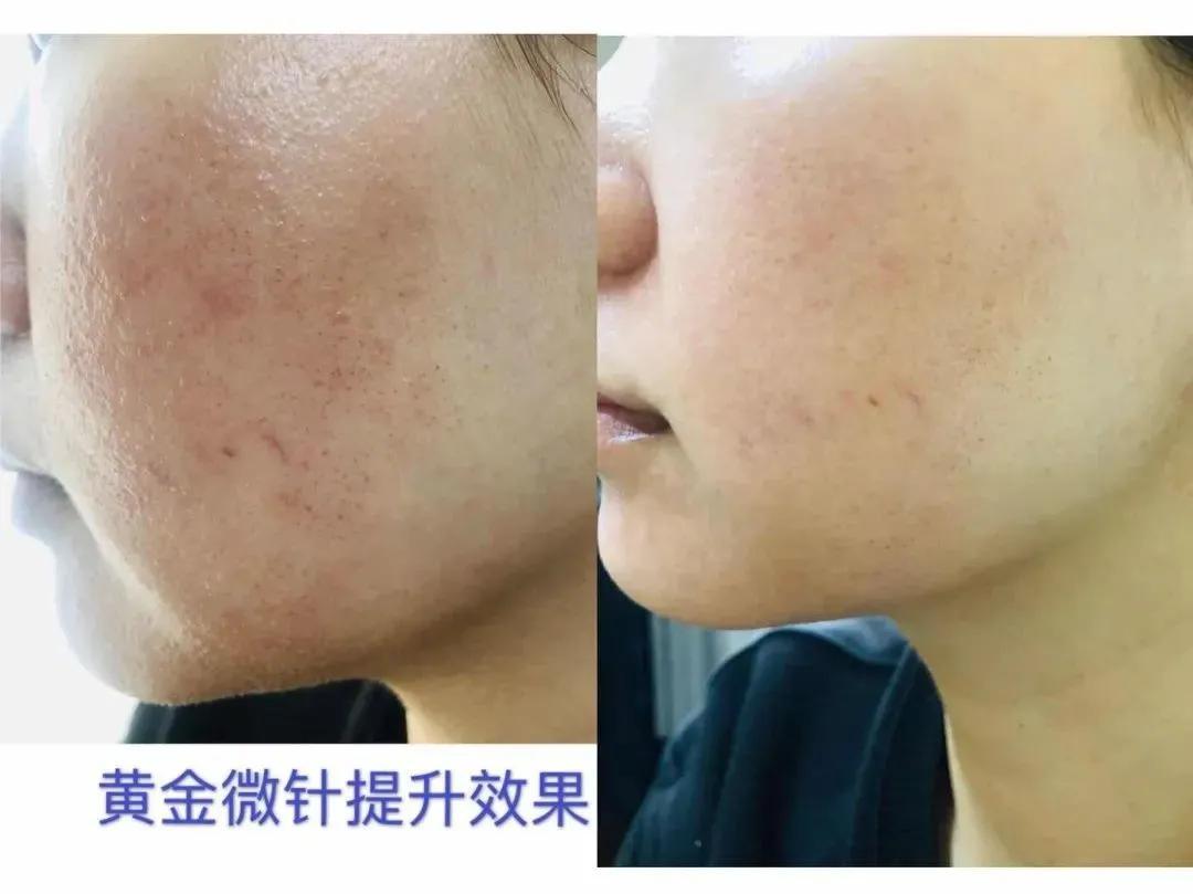 黄金微针,最被低估的贵妇医美项目