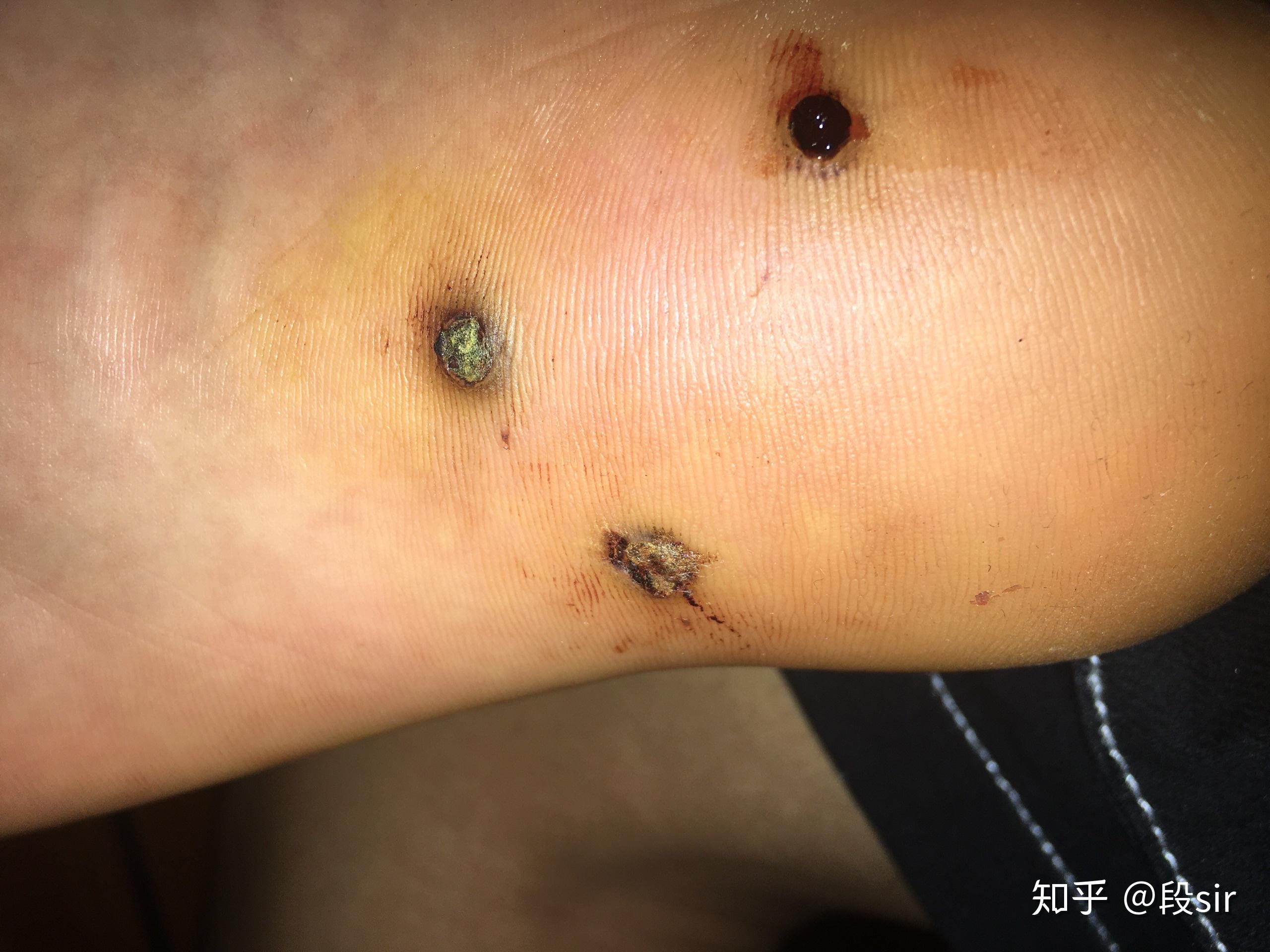 跖疣用激光的过程