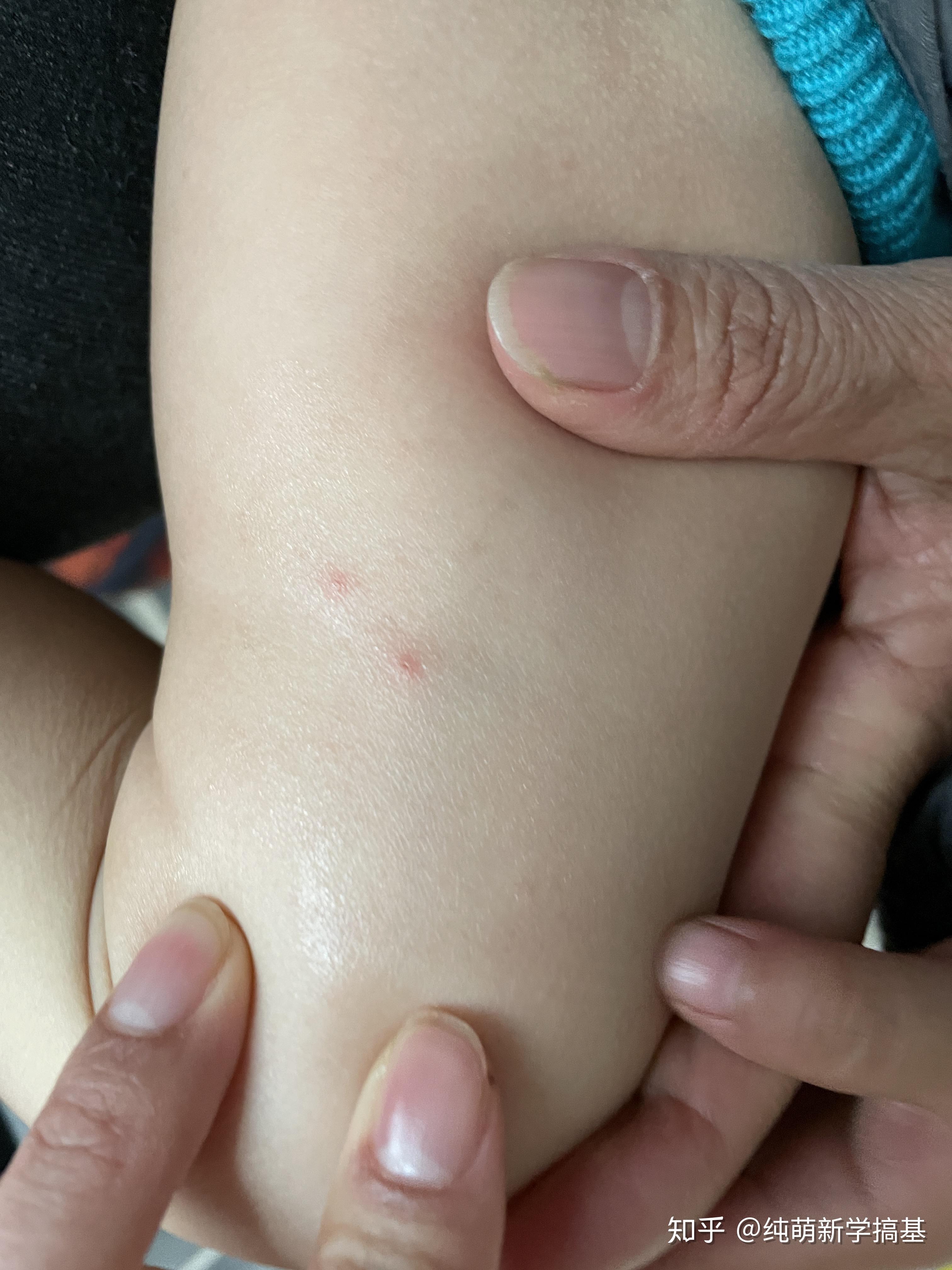 什么虫咬人是两个针眼大小的点?