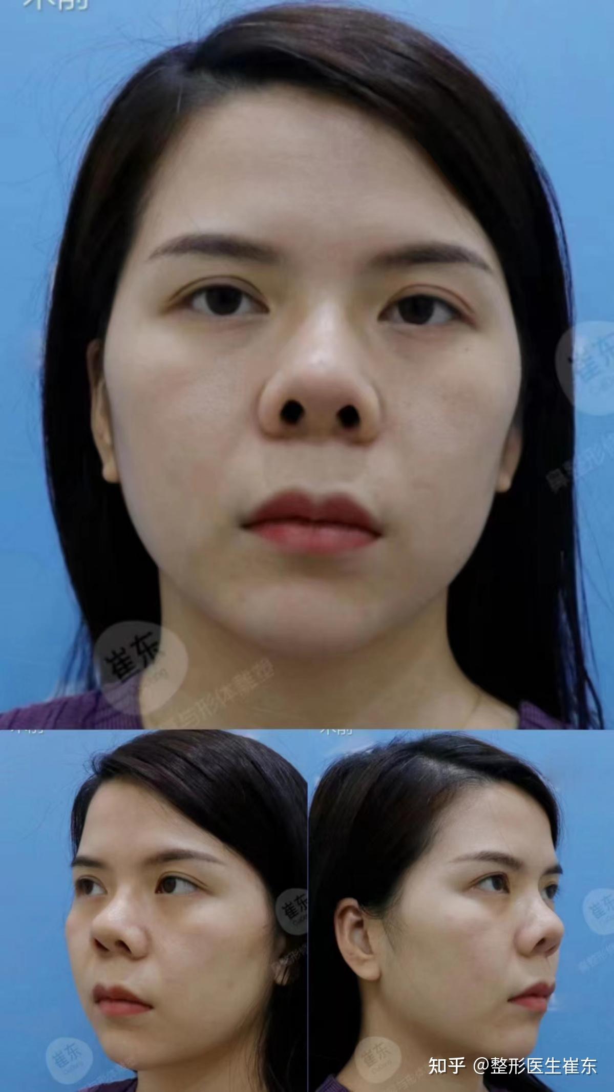 鼻修复案例 | 综合隆鼻修复案例合集（二）-蜜颜优惠