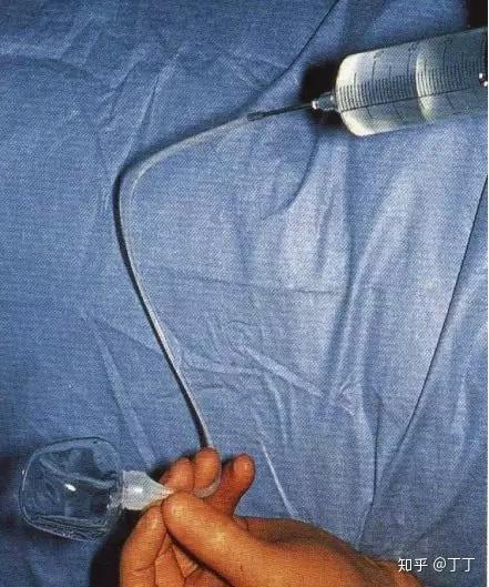 科普阴茎假体手术详解借助现代科技做一个能屈能伸的男人