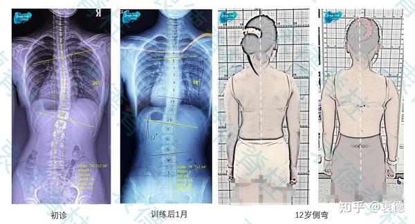 为什么侧弯好转,脊椎旋转(弯腰一边隆起)却没变化? - 知乎