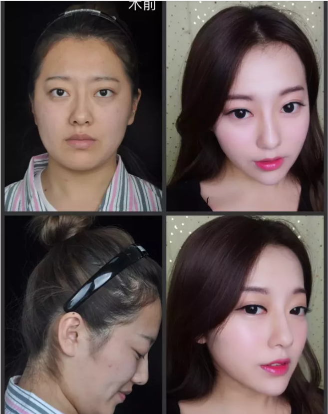 膨体下巴 下颌缘吸脂是种什么体验?案例反馈