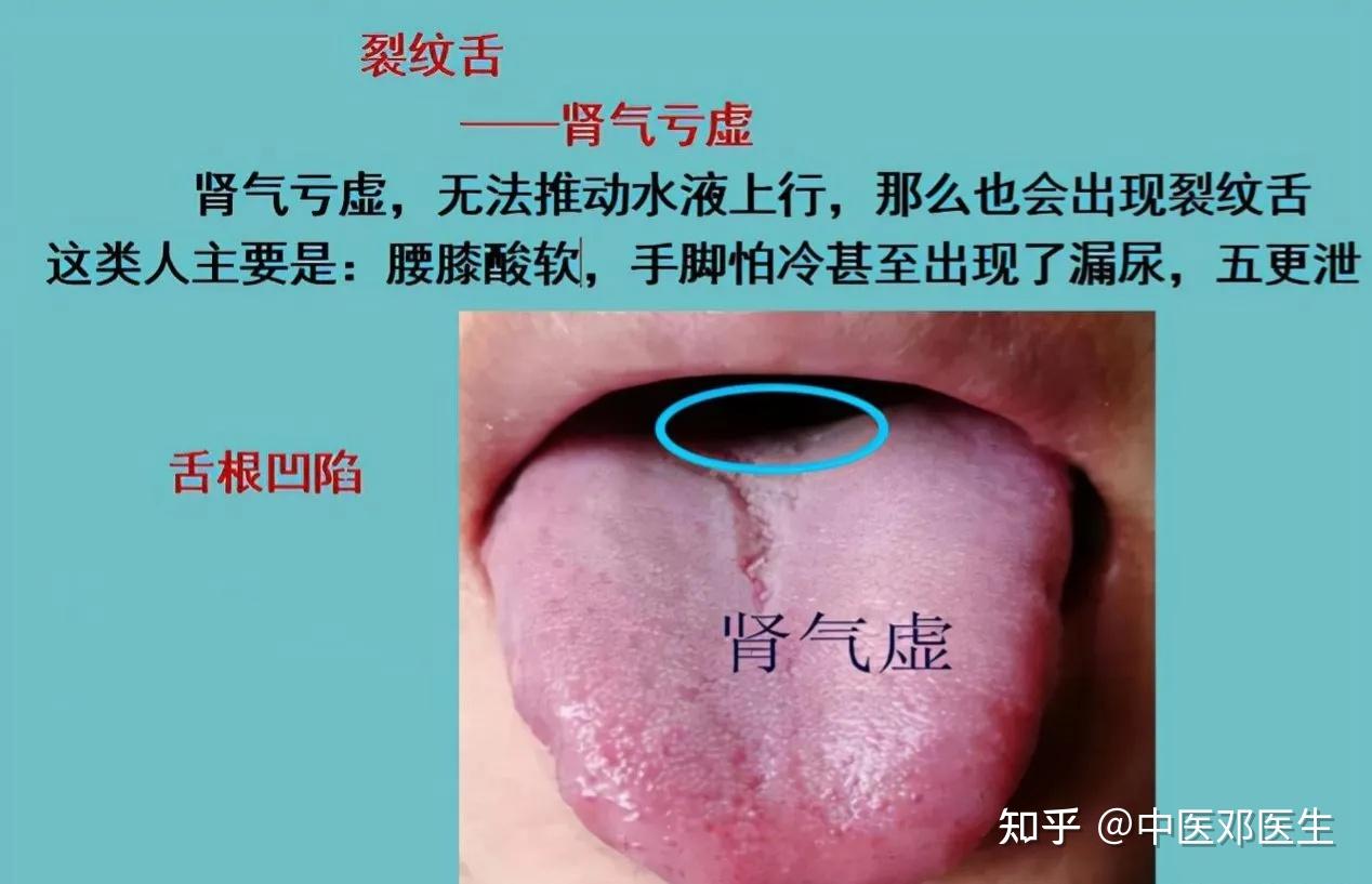 舌有裂纹除了是阴虚还要注意是气虚
