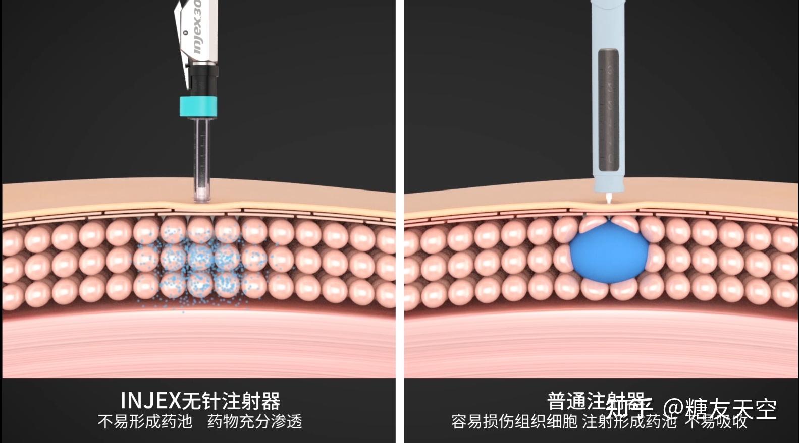 无针头注射器注射胰岛素有哪些好处