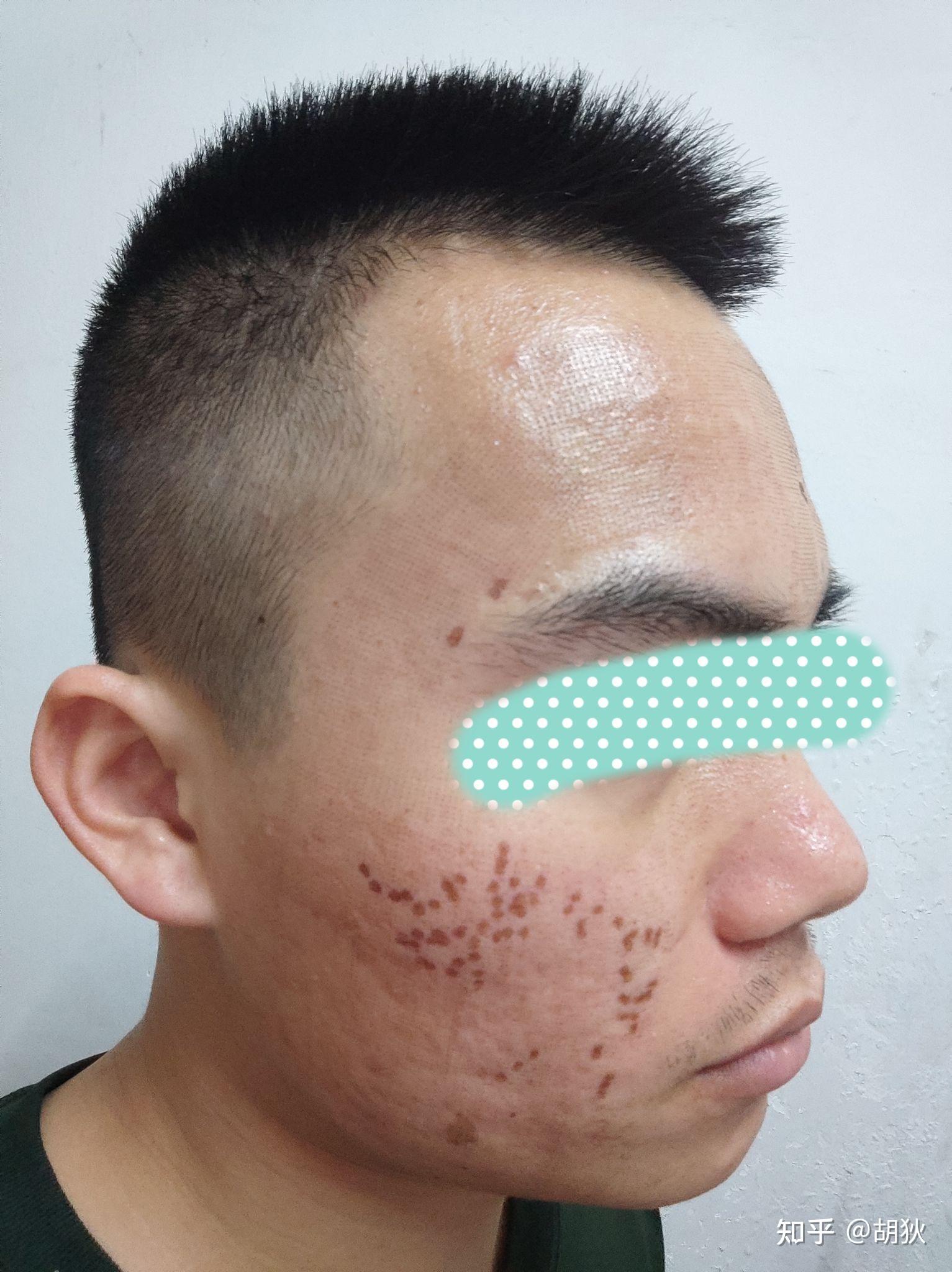 点阵激光祛痘坑经历