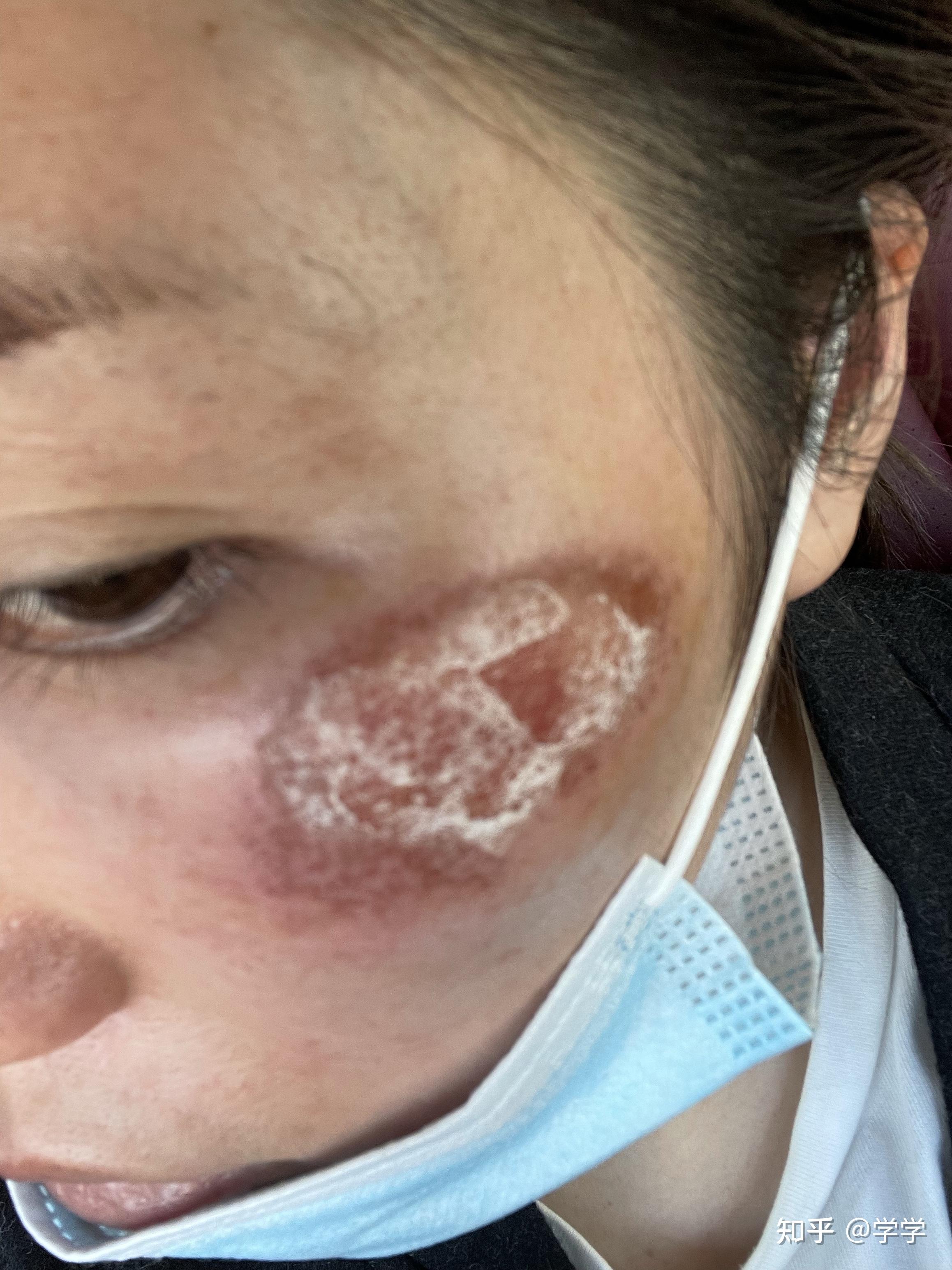 脸上有疤痕怎么办最快消除（脸上痘印痘疤是怎么形成的？如何快速的祛除？如何预防？） | 说明书网