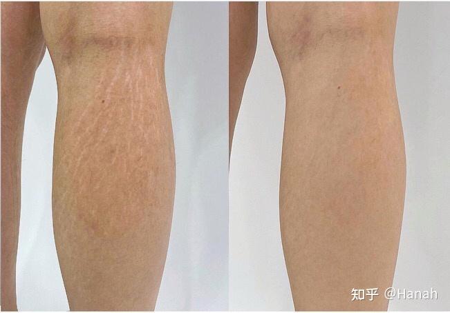 小腿肥胖纹试一下这个方法