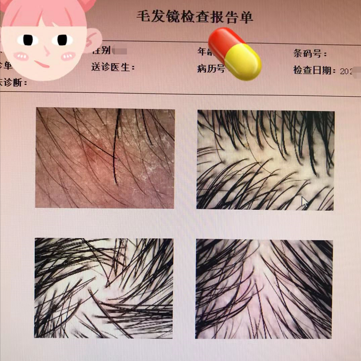大块大块地掉头皮屑,有什么好用的男士去屑洗发水推荐? - 知乎