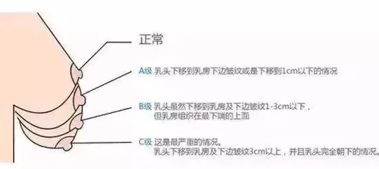 看定義前我們需要先認識關於乳房的兩個部位,乳頭和乳房下皺襞,下垂是