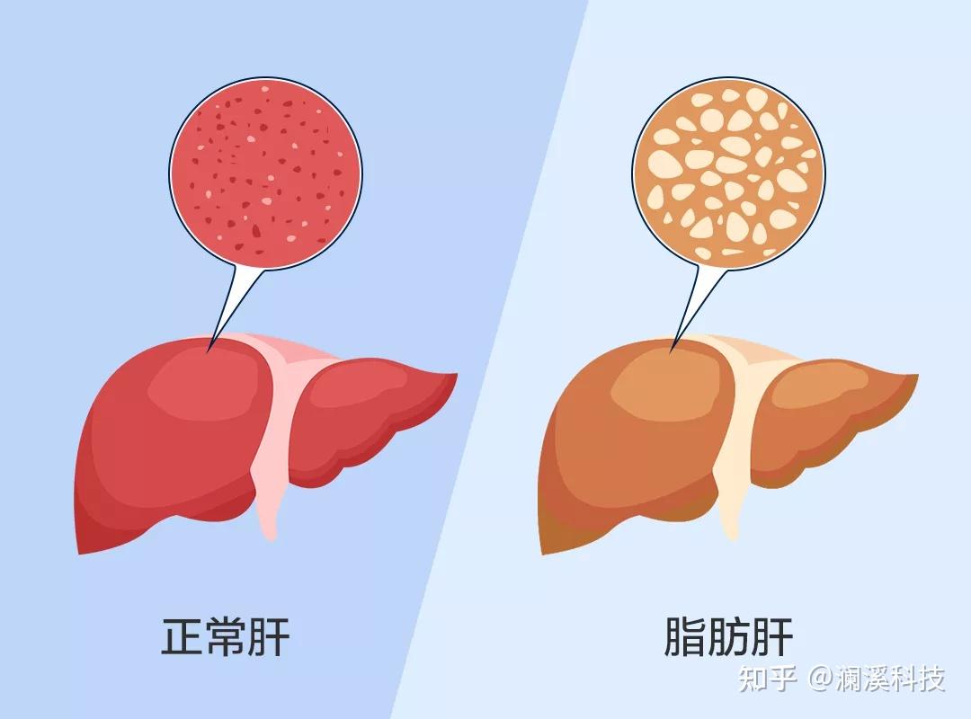 肝脏病变CT+MR影像图-肝脏图片-中国脂肪肝防治与康复网