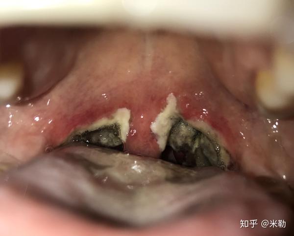 扁桃体手术后白膜图片图片