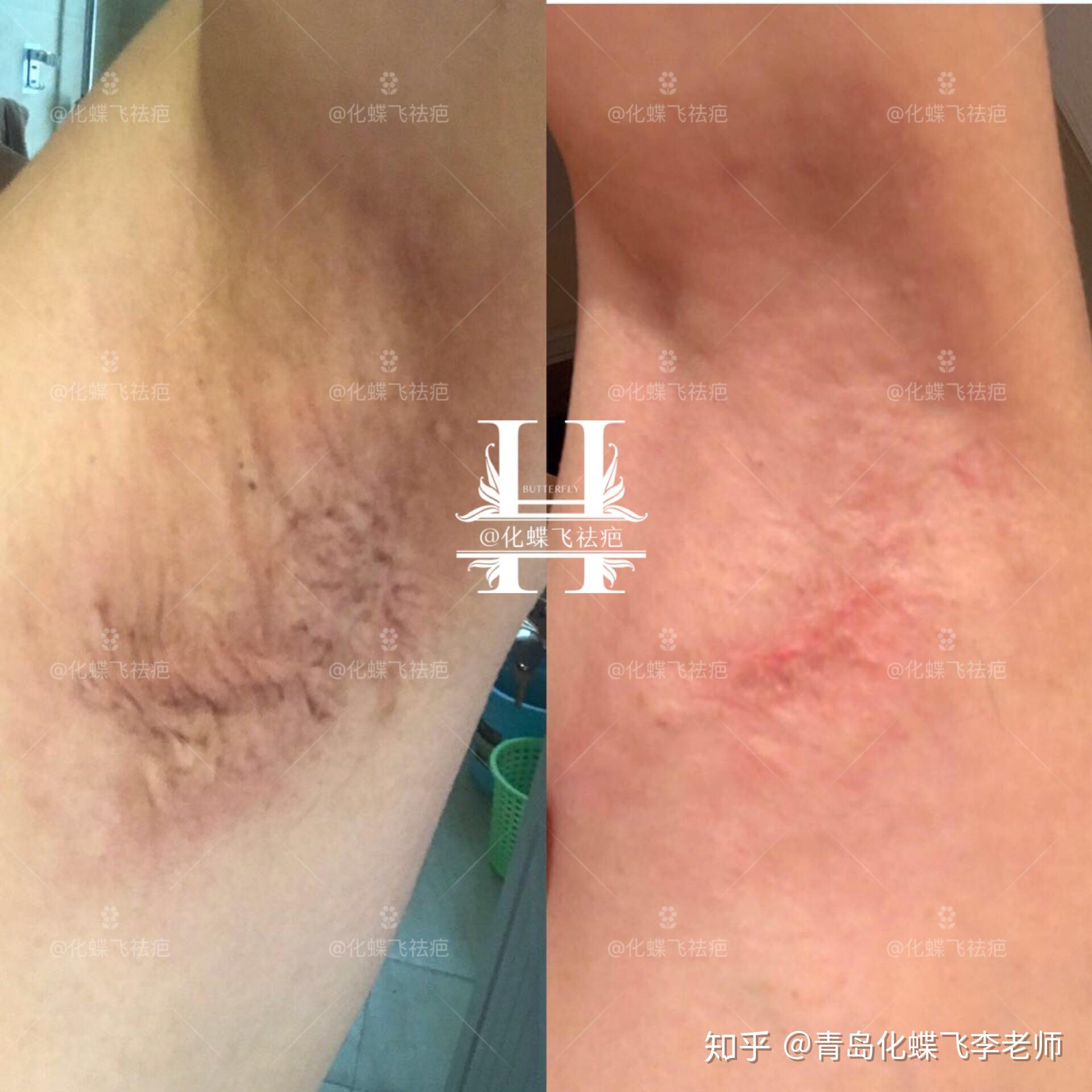 成都小姐姐的腋下手術疤痕恢復了80以上而且沒復發