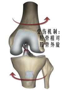 十字韌帶撕裂後羅斯還能回到巔峰嗎