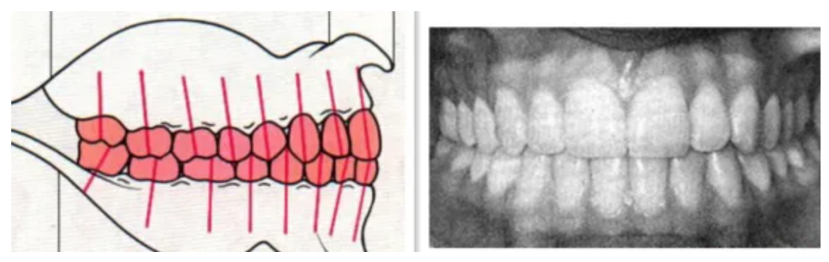 正确的咬合关系图片